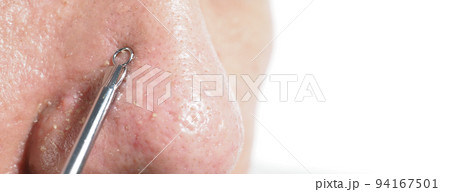 Acne and problem pores. Squeezing blackhead pimple with stainless steel medical acne remover tool. Pressing white and blackhead pimples from nose pores. Acne skin problem closeup. skin care treatment. Acne and problem pores. Squeezing blackhead pimple with stainless steel medical acne remover tool. Pressing white and blackhead pimples from nose pores. Acne skin problem closeup. skin care treatment. 94167501