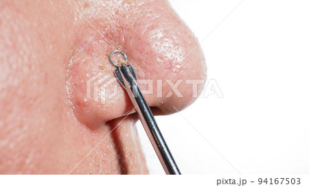 Acne and problem pores. Squeezing blackhead pimple with stainless steel medical acne remover tool. Pressing white and blackhead pimples from nose pores. Acne skin problem closeup. skin care treatment. Acne and problem pores. Squeezing blackhead pimple with stainless steel medical acne remover tool. Pressing white and blackhead pimples from nose pores. Acne skin problem closeup. skin care treatment. 94167503