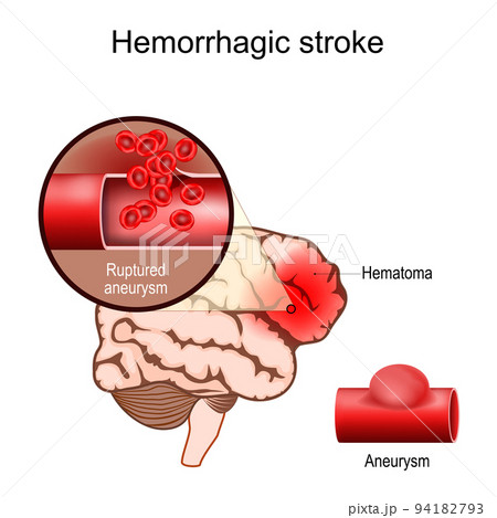 Hemorrhagic stroke. Human brain with Hematoma Hemorrhagic stroke. Human brain with Hematoma 94182793