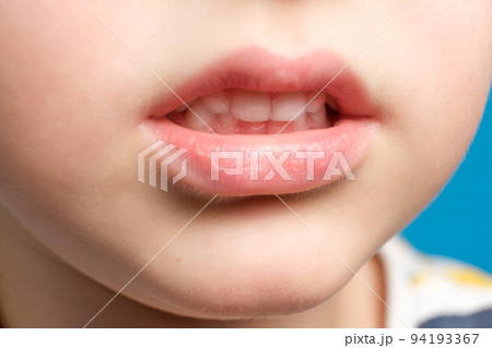 Children's milk teeth in a child, open mouth, close-up. Pediatric dentistry, thinned enamel Children's milk teeth in a child, open mouth, close-up. Pediatric dentistry, thinned enamel 94193367