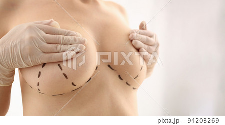 Woman with marks on chest for breast augmentation Woman with marks on chest for breast augmentation 94203269