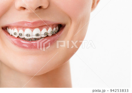 A smiling woman with metal braces. Close-up 94253833