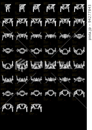 3DCT CTスキャン 右大腿骨転子部粉砕骨折 3DCT CTスキャン 右大腿骨転子部粉砕骨折 94277843