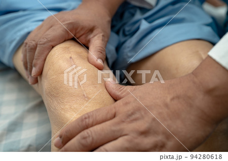 Asian senior or elderly old lady woman patient show her scars surgical total knee joint replacement Suture wound surgery arthroplasty on bed in nursing hospital ward, healthy strong medical concept. 94280618