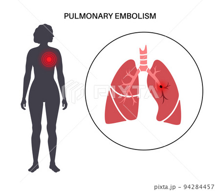 Pulmonary embolism disease 94284457