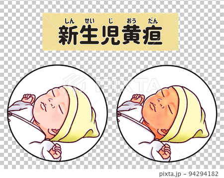 簡單易懂的日文插圖新生兒黃疸（病理性黃疸） 94294182