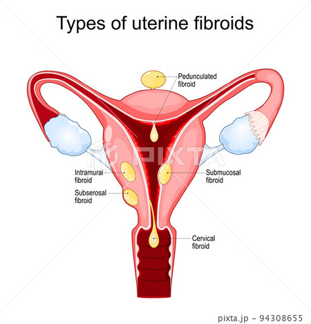 Uterine fibroids. Uterine fibroids. 94308655