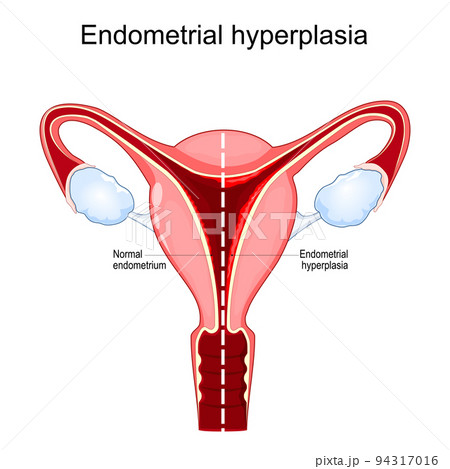 Endometrial hyperplasia 94317016