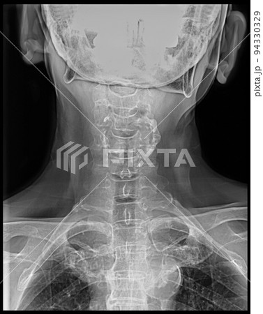 レントゲン写真 頸部レントゲン エックス線 レントゲン写真 頸部レントゲン エックス線 94330329