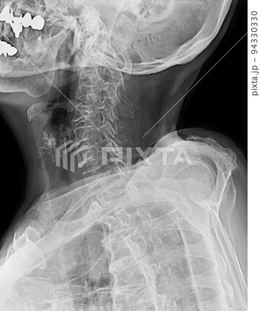 レントゲン写真 頸部レントゲン エックス線 レントゲン写真 頸部レントゲン エックス線 94330330