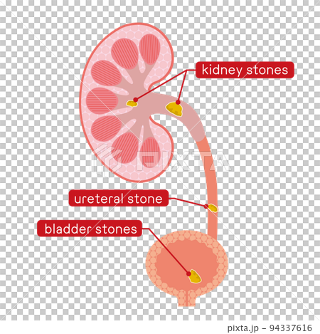 Explanation illustration of kidney and bladder stones Explanation illustration of kidney and bladder stones 94337616