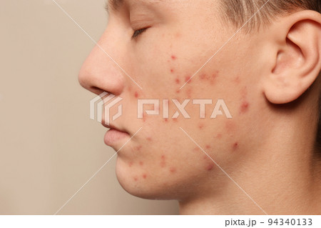 Teen guy with acne problem on beige background, closeup 94340133