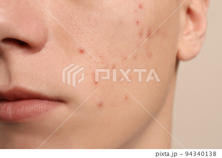 Teen guy with acne problem on beige background, closeup 94340138