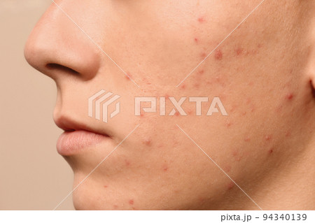 Teen guy with acne problem on beige background, closeup 94340139