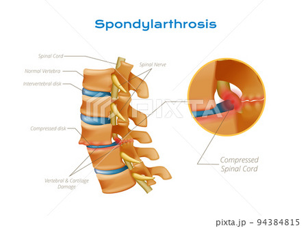 Spondylarthrosis Spinal Cord Infographics 94384815
