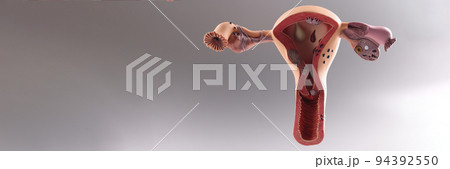 Closeup of artificial plastic model of uterus and ovaries on gray background 94392550