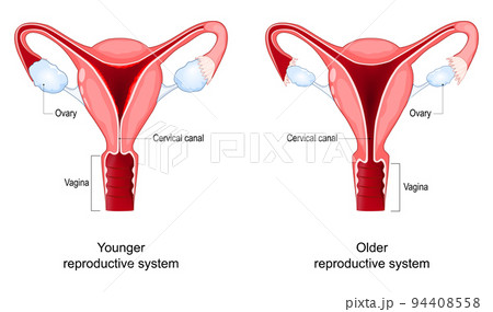 Menopause. Climacteric changes in the vagina, ovary and cervix. Menopause. Climacteric changes in the vagina, ovary and cervix. 94408558