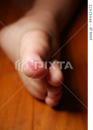 close up of 5 years old child injured feet on floor close up of 5 years old child injured feet on floor 94442472
