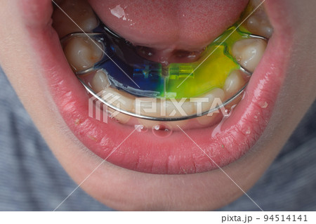 Mandibular plate, a boy wears a plate to align his teeth. Mandibular plate, a boy wears a plate to align his teeth. 94514141