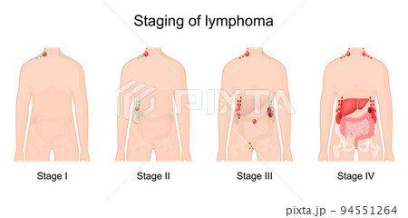 lymphoma stage. Cancer of the lymphatic system. 94551264