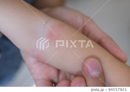 Woman hand holding infant leg. Red dry skin allergy from milk formula or other food. Closeup. Woman hand holding infant leg. Red dry skin allergy from milk formula or other food. Closeup. 94557921
