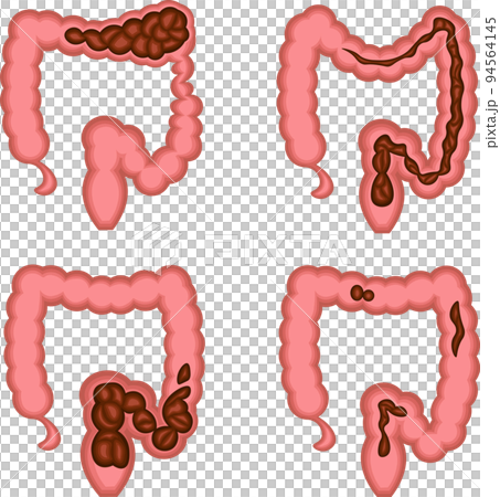 Functional constipation illustration 94564145