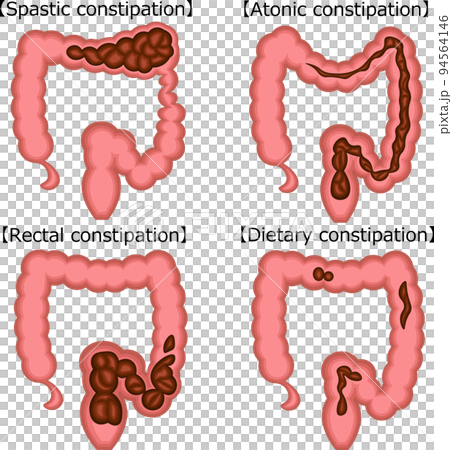 Functional constipation Illustration English 94564146