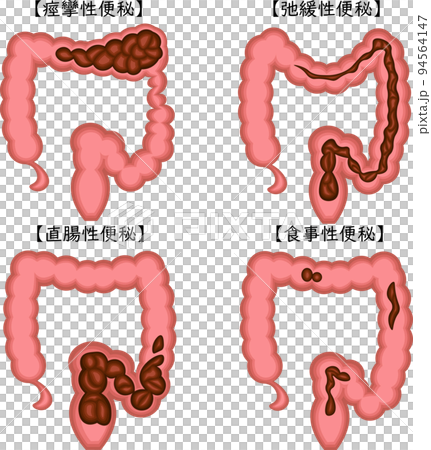 Functional constipation illustration Japanese 94564147