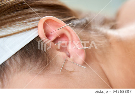 Beautiful woman relaxing on a bed having acupuncture treatment with needles in and around her ear. Alternative Therapy concept Beautiful woman relaxing on a bed having acupuncture treatment with needles in and around her ear. Alternative Therapy concept 94568807