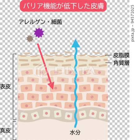 屏障功能低的皮膚 皮膚細胞和橫截面 94571025