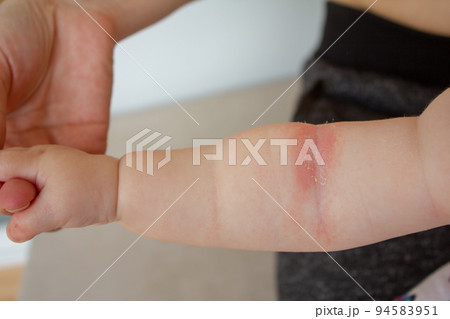 Prickly heat. Close-up of the folds of the hand of a newborn baby with red skin. Prickly heat. Close-up of the folds of the hand of a newborn baby with red skin. 94583951