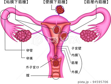 粘膜下筋腫　漿膜下筋腫　筋層内筋腫　イラスト　日本語 94595706