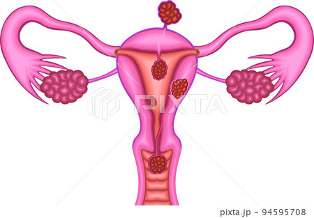 粘膜下筋腫 漿膜下筋腫 筋層内筋腫 イラスト 粘膜下筋腫 漿膜下筋腫 筋層内筋腫 イラスト 94595708