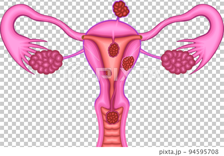 粘膜下筋腫 漿膜下筋腫 筋層内筋腫 イラスト 粘膜下筋腫 漿膜下筋腫 筋層内筋腫 イラスト 94595708