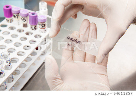 Scientist preparing a bone marrow smear in the laboratory. Blood smear. Scientist preparing a bone marrow smear in the laboratory. Blood smear. 94611857