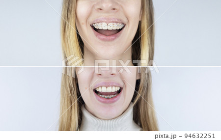 Before and after remove braces. On left is a girl in a metal bracket system, and on right are straight teeth after the procedure. Concept of correcting a smile and straightening teeth. Close-up 94632251