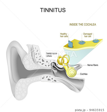 Tinnitus. Human ear. 94635915