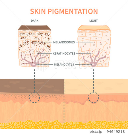 Skin tone pigmentation mechanism infographic medical diagram 94649218