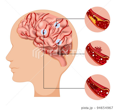 Human with common types of stroke infographic Human with common types of stroke infographic 94654967
