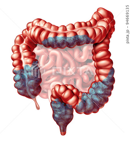 Constipation Anatomy Constipation Anatomy 94669135