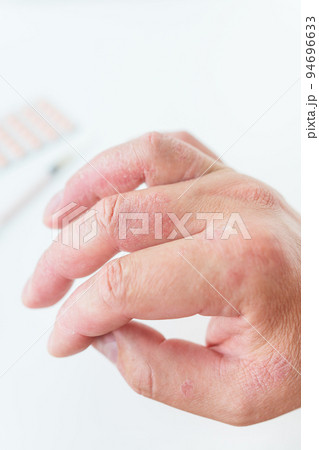 A man shows a reddening rash on his hands. The causes of itchy skin can be dermatitis (eczema), dry skin, burns, food allergies. healthcare concept. A man shows a reddening rash on his hands. The causes of itchy skin can be dermatitis (eczema), dry skin, burns, food allergies. healthcare concept. 94696633
