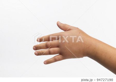 Swollen hand from allergic of insect stings. Skin allergic care. Swollen hand from allergic of insect stings. Skin allergic care. 94727190