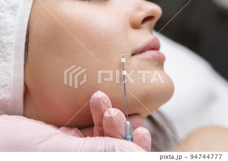 Face lifting PDO Suture operation. innovative technique of New thread lift, cosmetologist preparing to do procedure to female client, select the appropriate thread option Face lifting PDO Suture operation. innovative technique of New thread lift, cosmetologist preparing to do procedure to female client, select the appropriate thread option 94744777