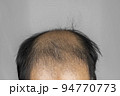 薄毛男性の前頭部（日本人、30代） 94770773