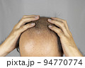 頭を押さえる薄毛男性の前頭部（日本人、30代） 94770774