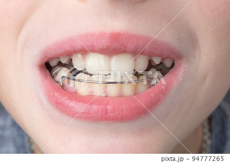 The boy wears a dental plate on his lower jaw. 94777265