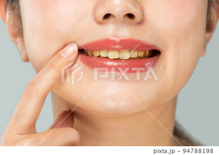 黄ばんだ女性の歯 黄ばんだ女性の歯 94788198
