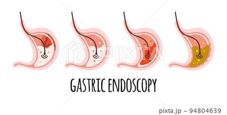The stomach of a healthy person, with ulcers, gastritis, acidity. Gastroenterology. Vector illustration in a flat style. The stomach of a healthy person, with ulcers, gastritis, acidity. Gastroenterology. Vector illustration in a flat style. 94804639