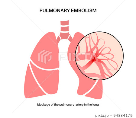 Pulmonary embolism disease 94834179