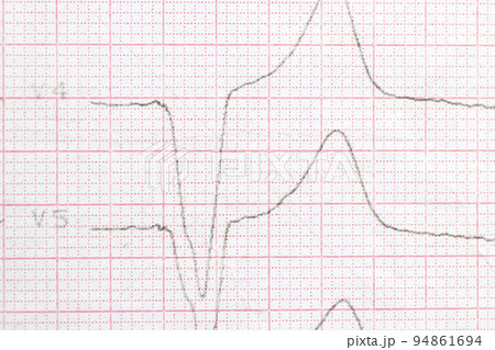 Macro photo of ECG cardiogram of a patient with a heart attack. 94861694